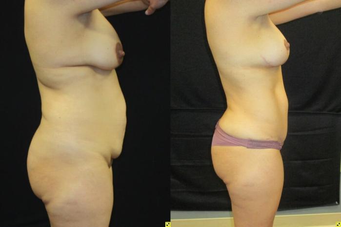 Before & After Mommy Makeover Case 96 View 3 View in Savannah, GA