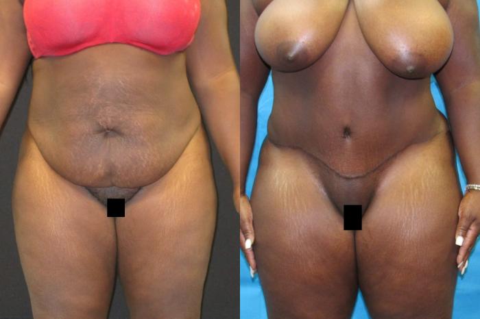 Before & After Tummy Tuck Case 100 View 1 View in Savannah, GA