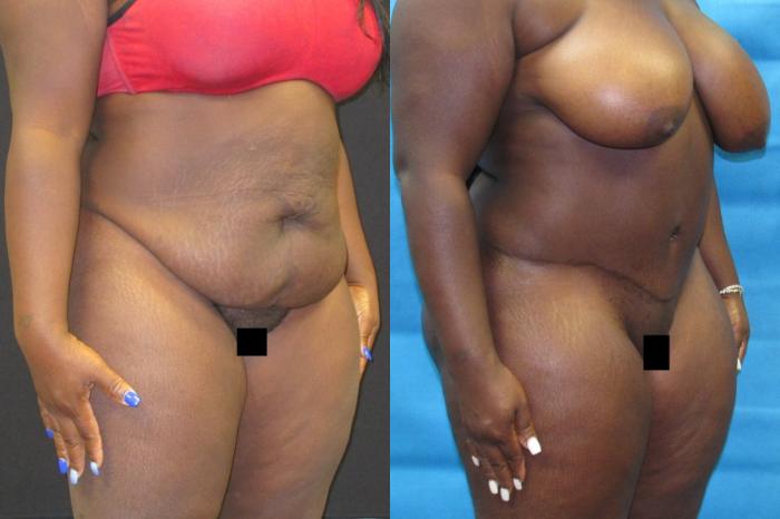Before & After Tummy Tuck Case 100 View 2 View in Savannah, GA