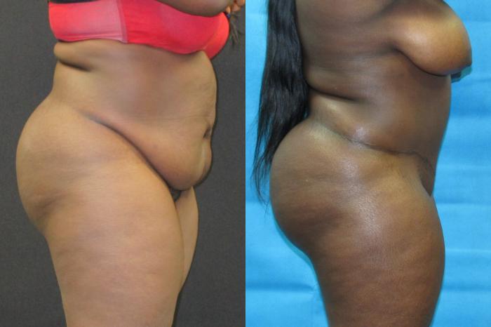 Before & After Tummy Tuck Case 100 View 3 View in Savannah, GA