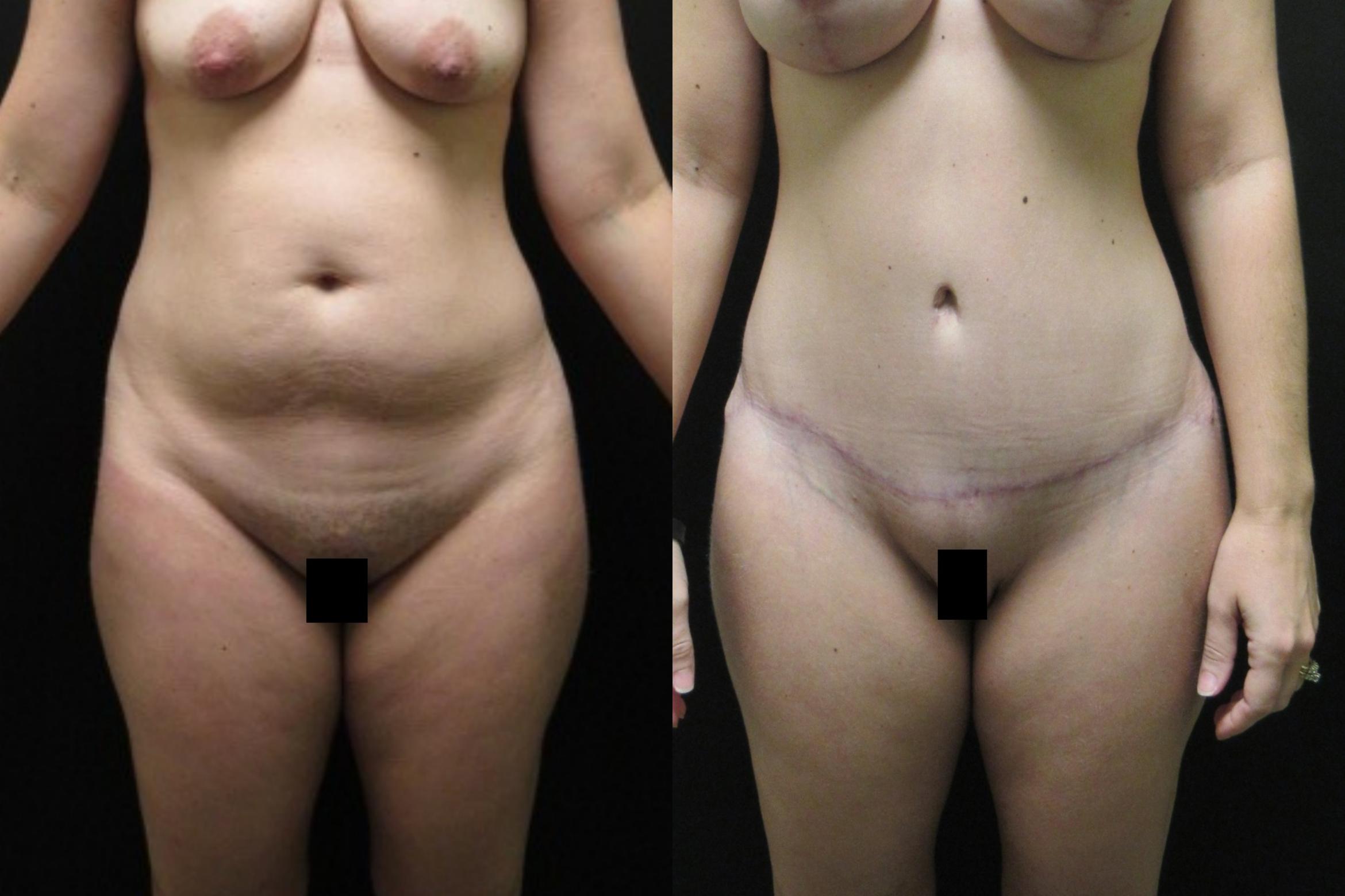 Before & After Tummy Tuck Case 101 View 1 View in Savannah, GA