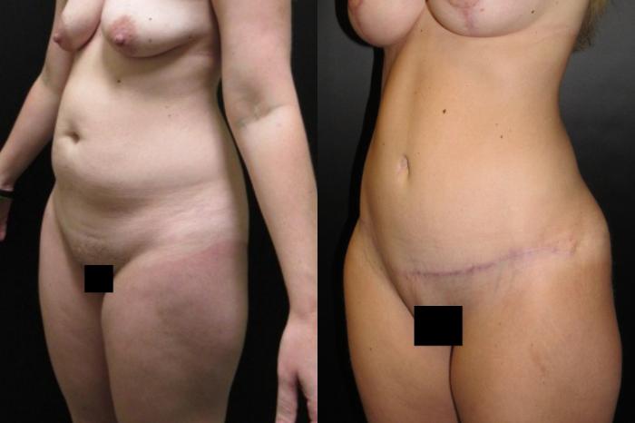 Before & After Tummy Tuck Case 101 View 2 View in Savannah, GA