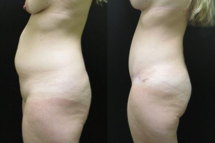 Before & After Tummy Tuck Case 101 View 3 View in Savannah, GA