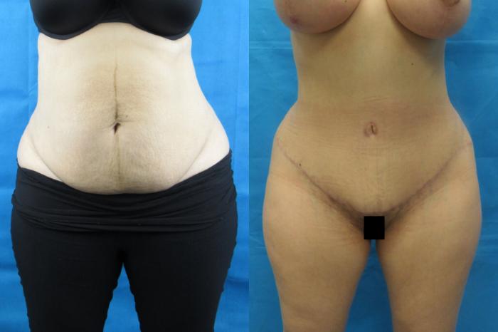 Before & After Tummy Tuck Case 103 View 1 View in Savannah, GA