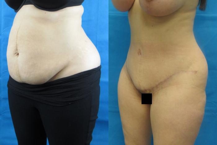 Before & After Tummy Tuck Case 103 View 2 View in Savannah, GA