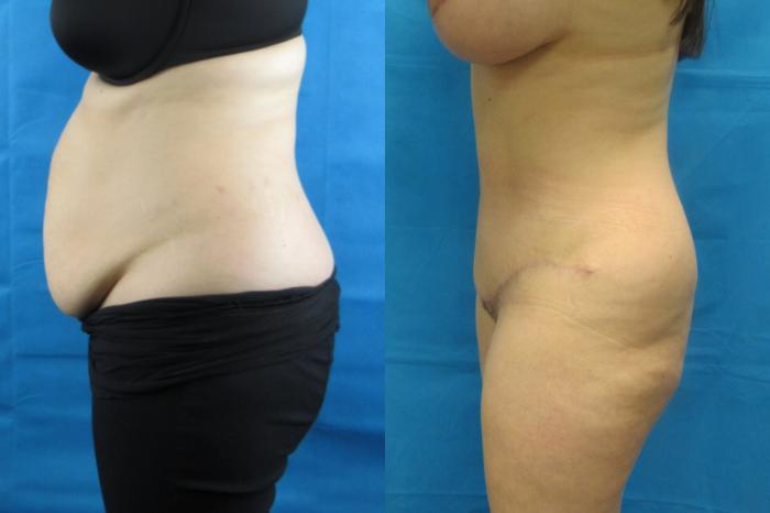 Before & After Tummy Tuck Case 103 View 3 View in Savannah, GA