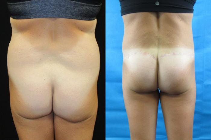 Before & After Tummy Tuck Case 104 View 4 View in Savannah, GA