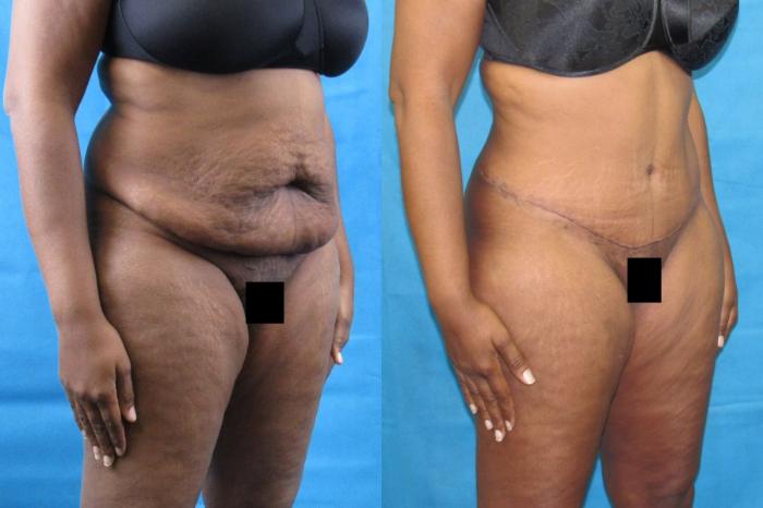 Before & After Tummy Tuck Case 105 View 2 View in Savannah, GA