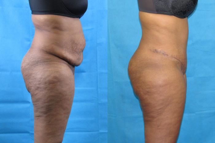 Before & After Tummy Tuck Case 105 View 3 View in Savannah, GA