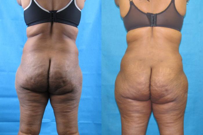 Before & After Tummy Tuck Case 105 View 4 View in Savannah, GA
