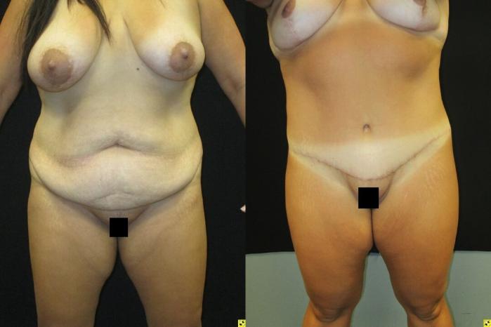 Before & After Tummy Tuck Case 106 View 1 View in Savannah, GA