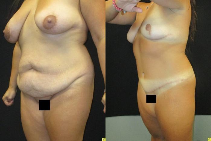 Before & After Tummy Tuck Case 106 View 2 View in Savannah, GA