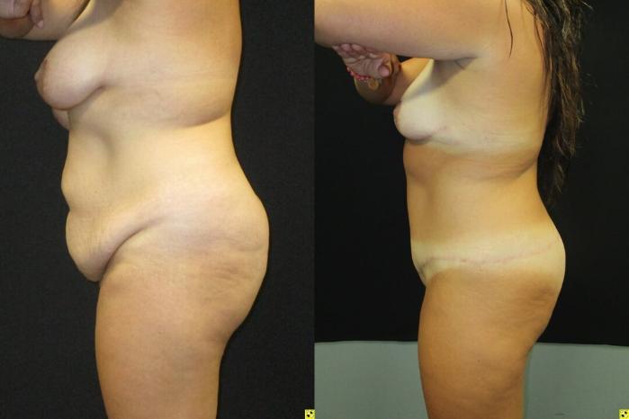 Before & After Tummy Tuck Case 106 View 3 View in Savannah, GA