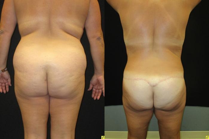 Before & After Tummy Tuck Case 106 View 4 View in Savannah, GA
