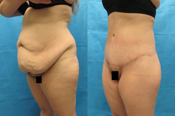 Before & After Tummy Tuck Case 108 View 2 View in Savannah, GA