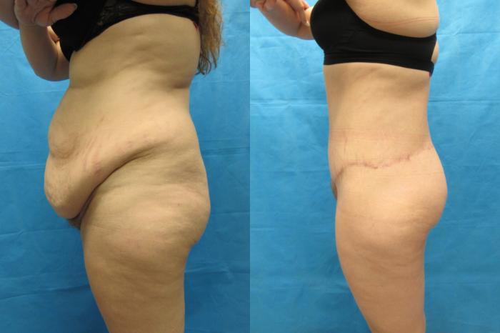 Before & After Tummy Tuck Case 108 View 3 View in Savannah, GA