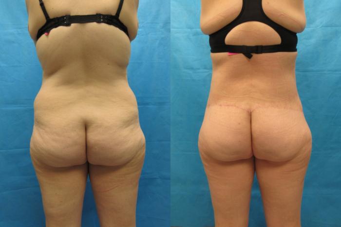 Before & After Tummy Tuck Case 108 View 4 View in Savannah, GA