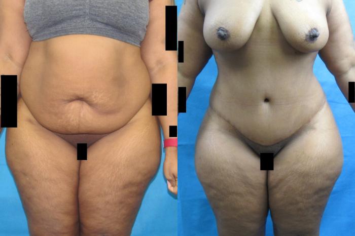 Before & After Tummy Tuck Case 109 View 1 View in Savannah, GA