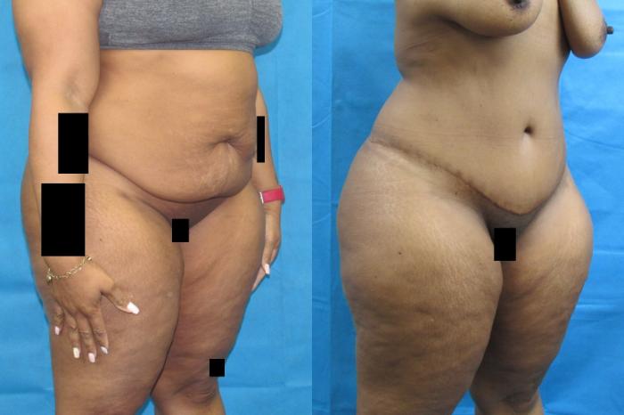 Before & After Tummy Tuck Case 109 View 2 View in Savannah, GA