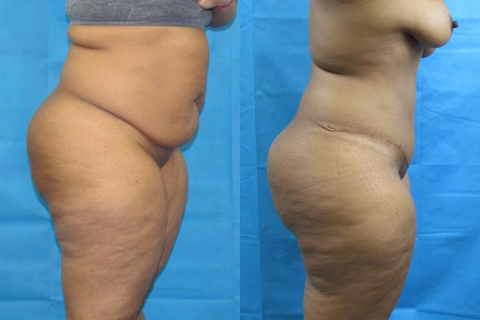 Before & After Tummy Tuck Case 109 View 3 View in Savannah, GA