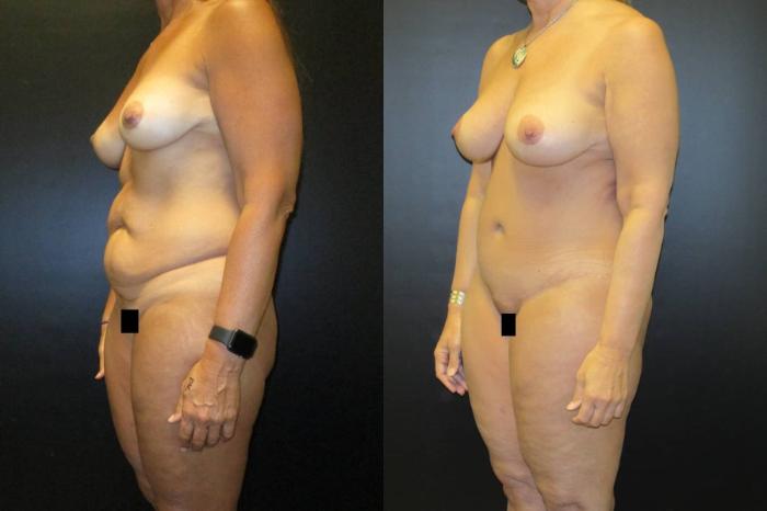 Before & After Tummy Tuck Case 110 View 2 View in Savannah, GA