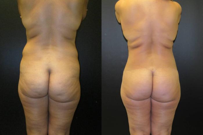 Before & After Tummy Tuck Case 110 View 3 View in Savannah, GA