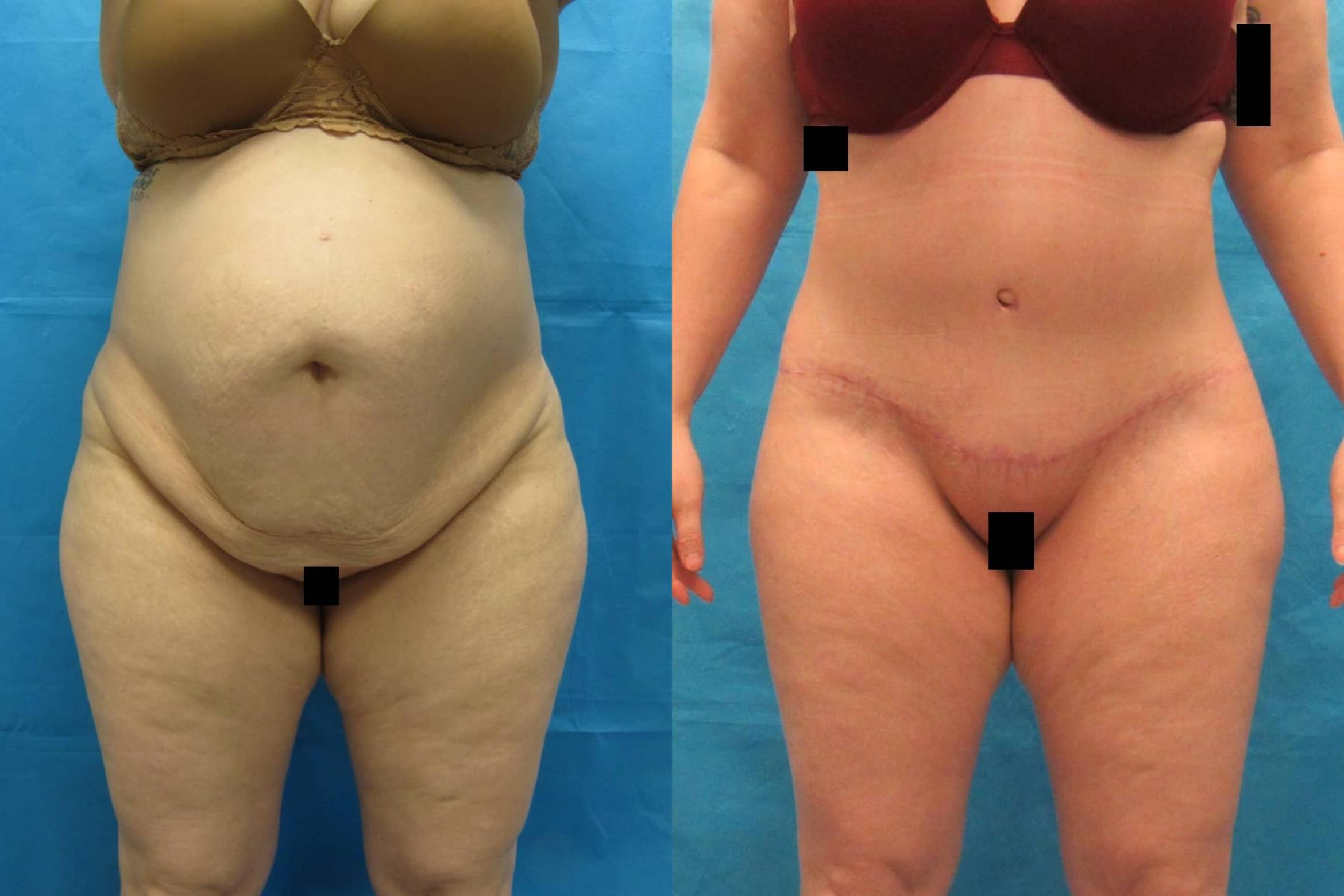 Before & After Tummy Tuck Case 112 View 1 View in Savannah, GA