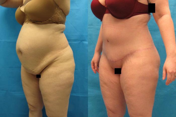 Before & After Tummy Tuck Case 112 View 2 View in Savannah, GA