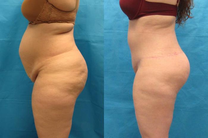 Before & After Tummy Tuck Case 112 View 3 View in Savannah, GA