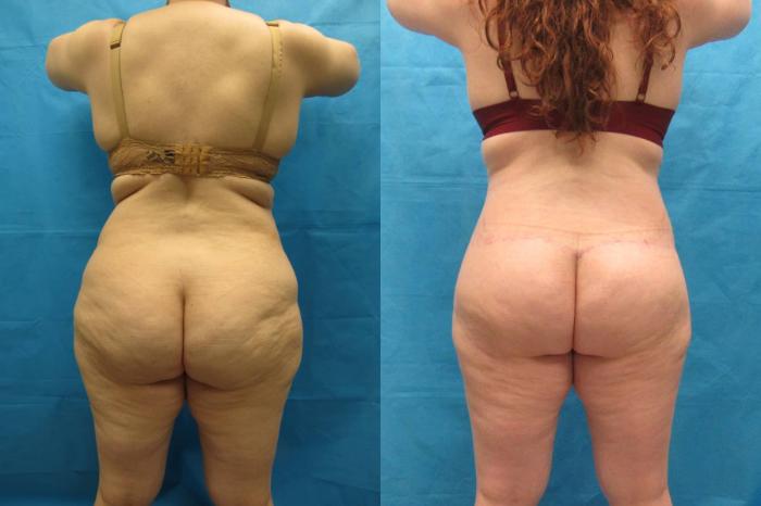 Before & After Tummy Tuck Case 112 View 4 View in Savannah, GA