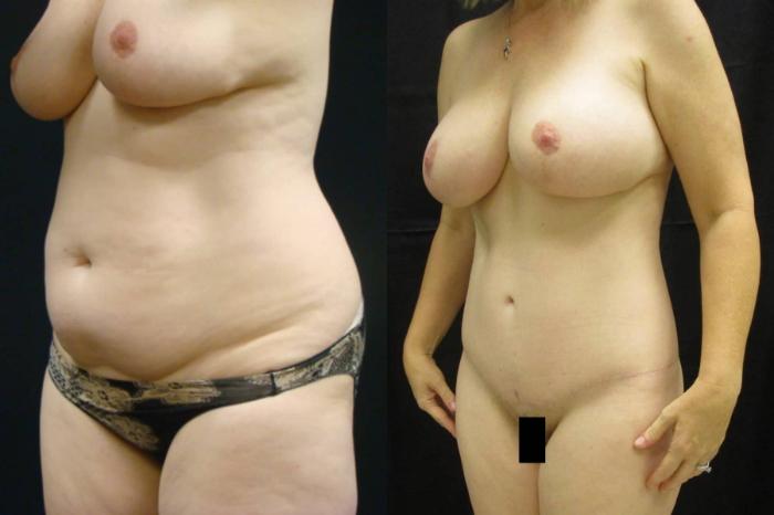 Before & After Tummy Tuck Case 113 View 2 View in Savannah, GA