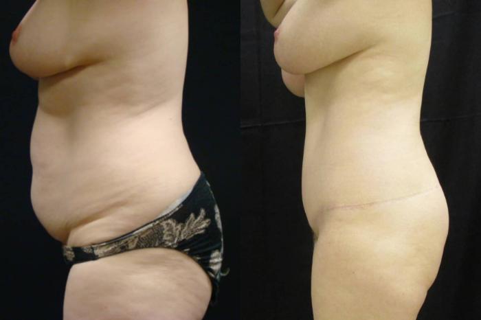 Before & After Tummy Tuck Case 113 View 3 View in Savannah, GA