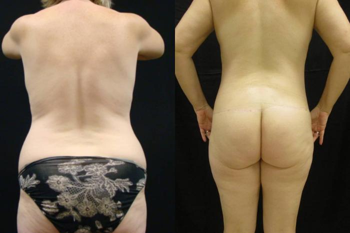 Before & After Tummy Tuck Case 113 View 4 View in Savannah, GA