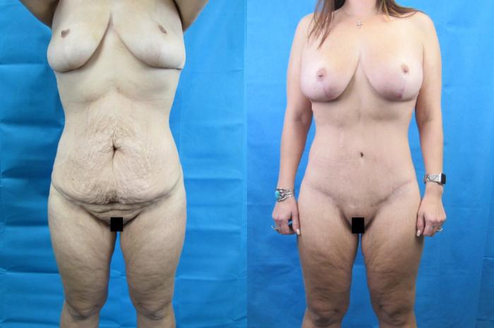 Before & After Tummy Tuck Case 114 View 1 View in Savannah, GA