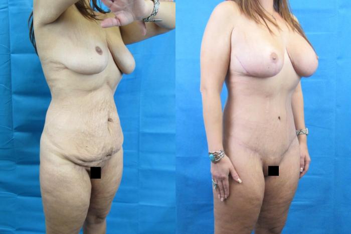 Before & After Tummy Tuck Case 114 View 2 View in Savannah, GA