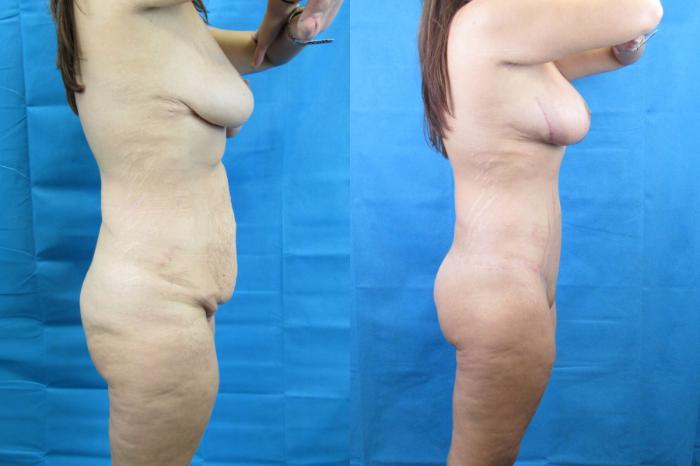 Before & After Tummy Tuck Case 114 View 3 View in Savannah, GA