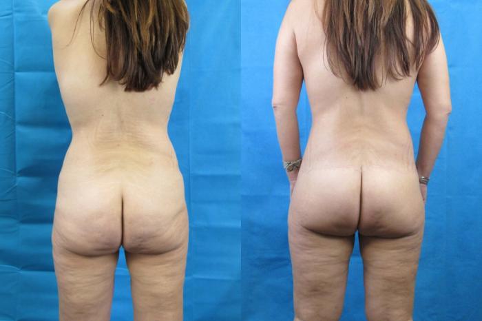 Before & After Tummy Tuck Case 114 View 4 View in Savannah, GA