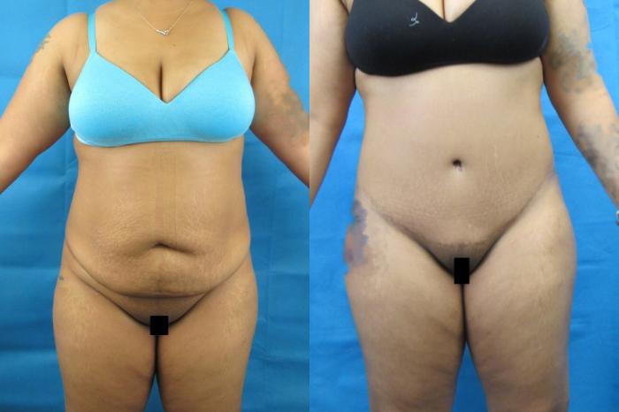 Before & After Tummy Tuck Case 115 View 1 View in Savannah, GA
