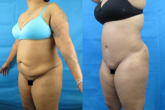 Before & After Tummy Tuck Case 115 View 2 View in Savannah, GA