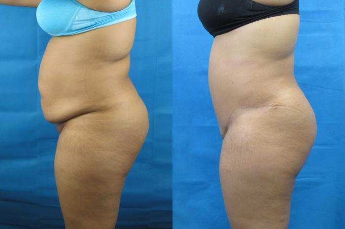 Before & After Tummy Tuck Case 115 View 3 View in Savannah, GA