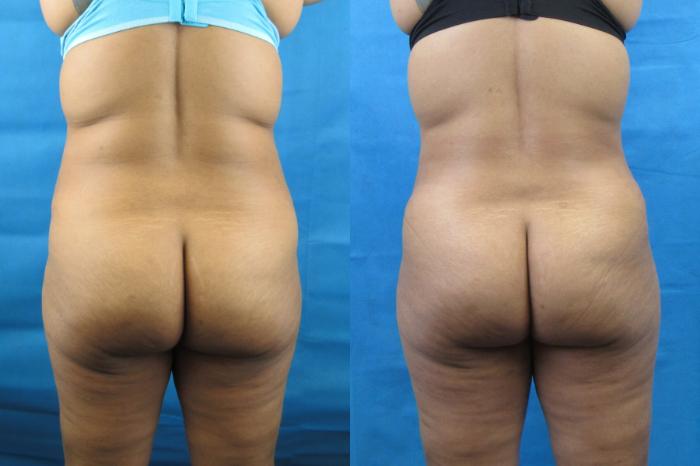 Before & After Tummy Tuck Case 115 View 4 View in Savannah, GA