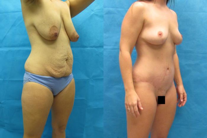 Before & After Tummy Tuck Case 117 View 2 View in Savannah, GA