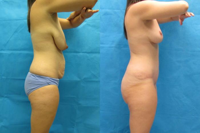 Before & After Tummy Tuck Case 117 View 3 View in Savannah, GA