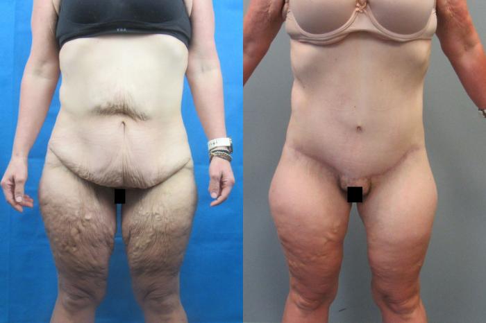 Before & After Tummy Tuck Case 118 View 1 View in Savannah, GA