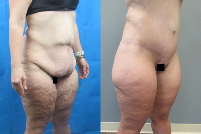 Before & After Tummy Tuck Case 118 View 2 View in Savannah, GA