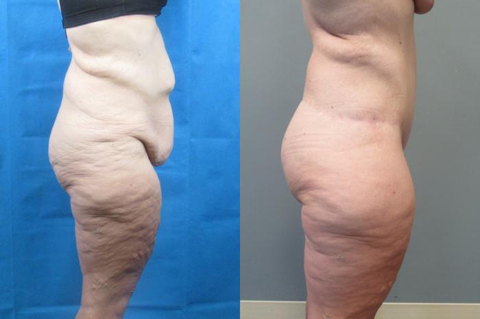 Before & After Tummy Tuck Case 118 View 3 View in Savannah, GA