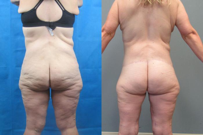 Before & After Tummy Tuck Case 118 View 4 View in Savannah, GA