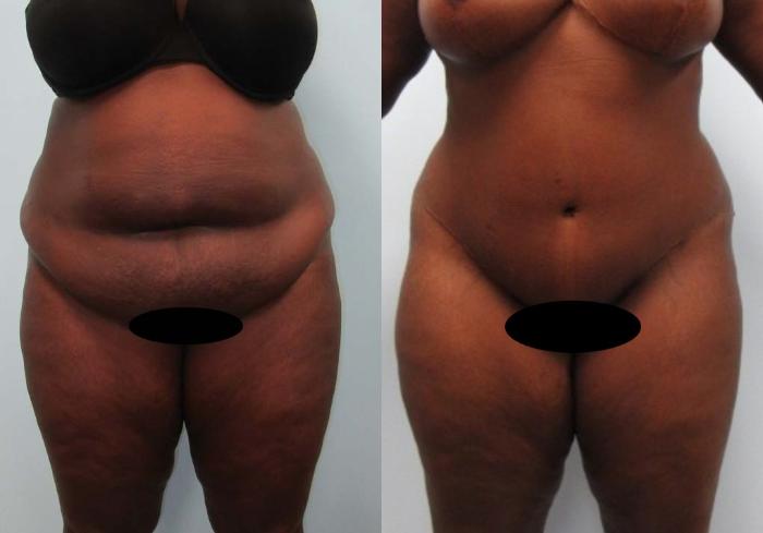 Before & After Tummy Tuck Case 120 View 1 View in Savannah, GA