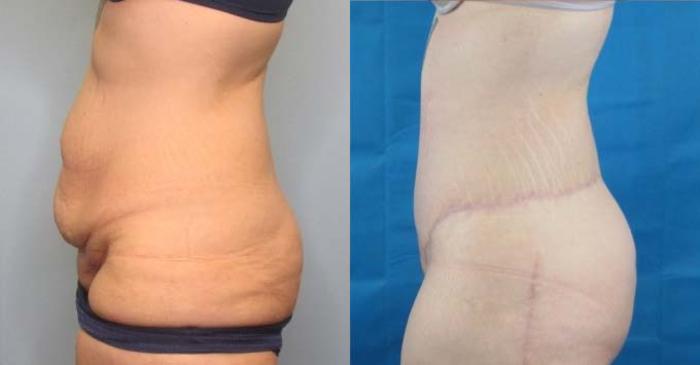 Before & After Tummy Tuck Case 122 View 2 View in Savannah, GA