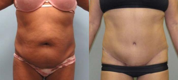 Before & After Tummy Tuck Case 124 View 1 View in Savannah, GA
